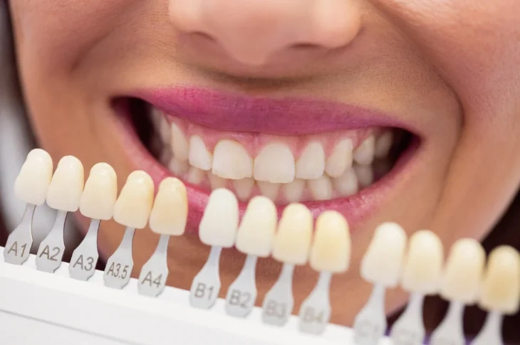 Teeth Whitening: What Methods Are Available?