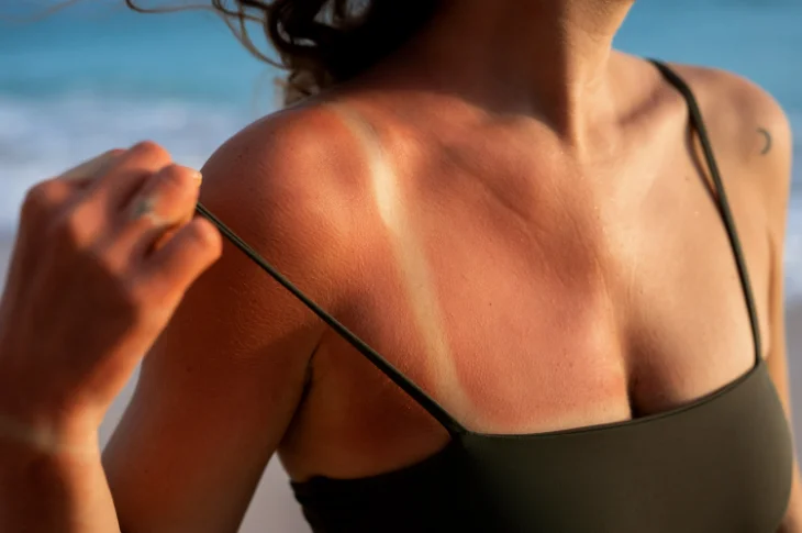 Ādas aprūpe pēc saules vai solārija: dermatologa padomi
