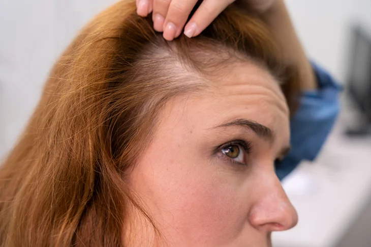 androgena-alopecija-ka-trihologs-diagnostice-un-arste