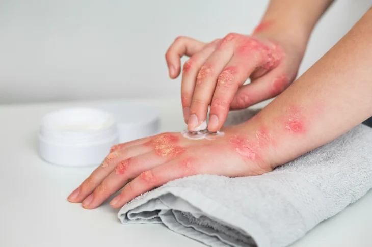 Atopiskais dermatīts bērnam: kā to atpazīt un ārstēt?
