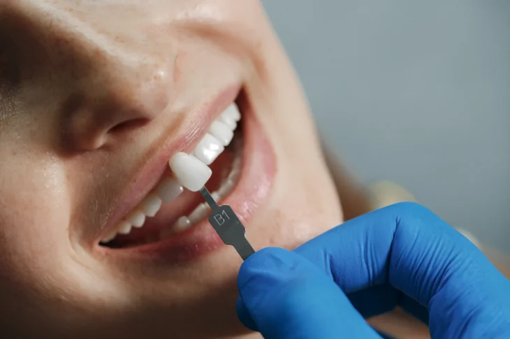 Dental Crowns or a Bridge: How to Choose the Best Solution?