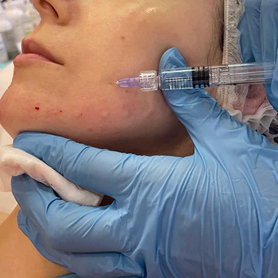 Biorevitalizācija